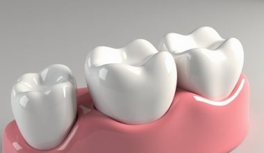 durable aesthetic dental restoration