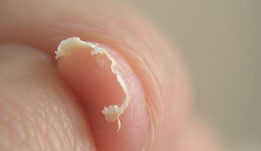 nail chipping nutrition deficiency indicator